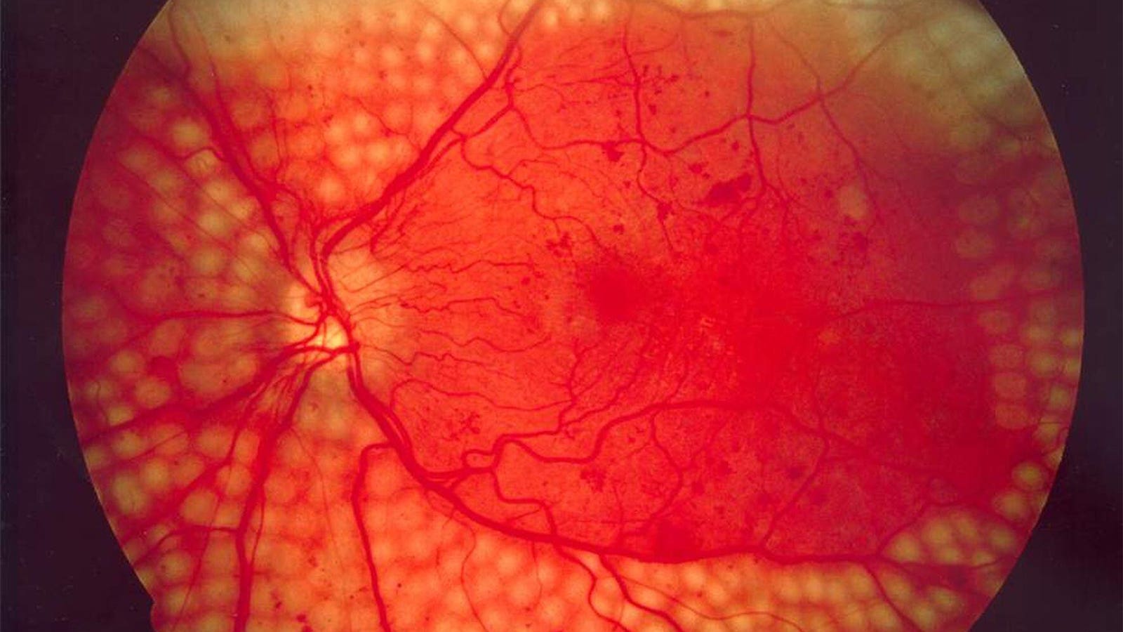 Combo Anesthesia During Retinal Laser Treatment Reduced Pain Perception