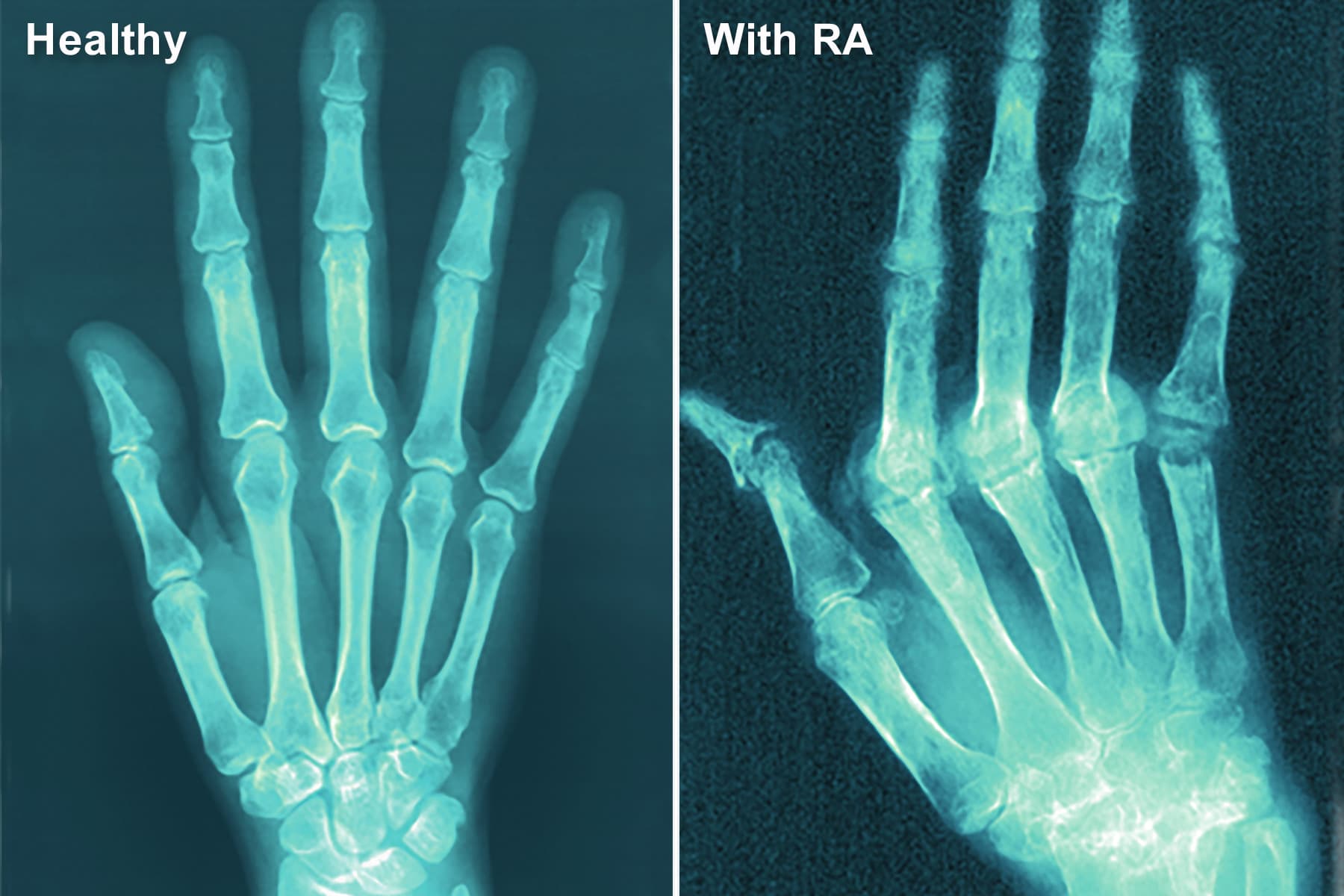 FDA Warns of Hidden Ingredients in Arthritis, Pain Products