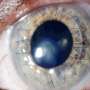 Study reveals untapped potential to increase eye donations needed for sight-restoring surgeries