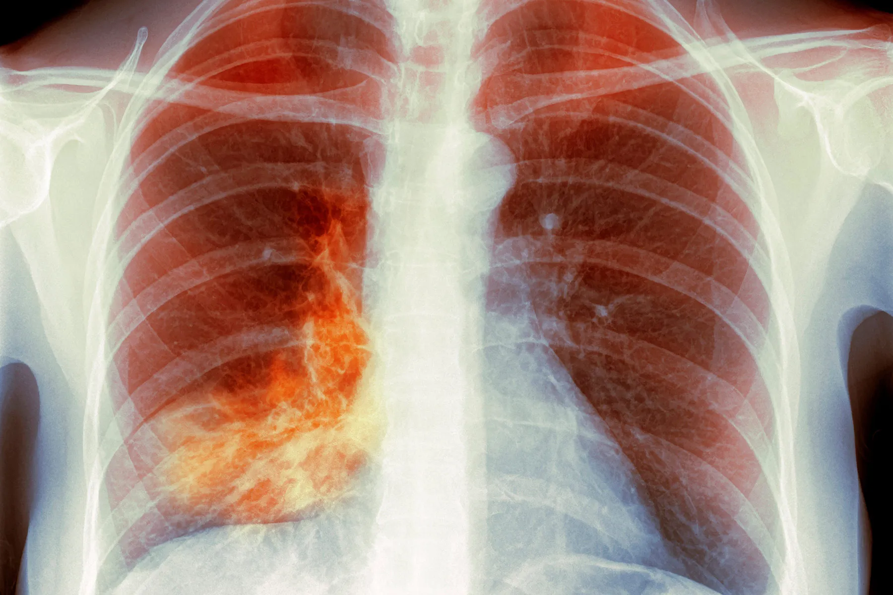 Q&A: ‘White Lung’ Pneumonia – What You Need to Know
