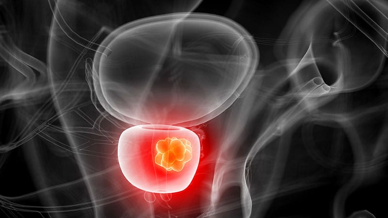 More Side Effects With Local Therapies for Prostate Cancer