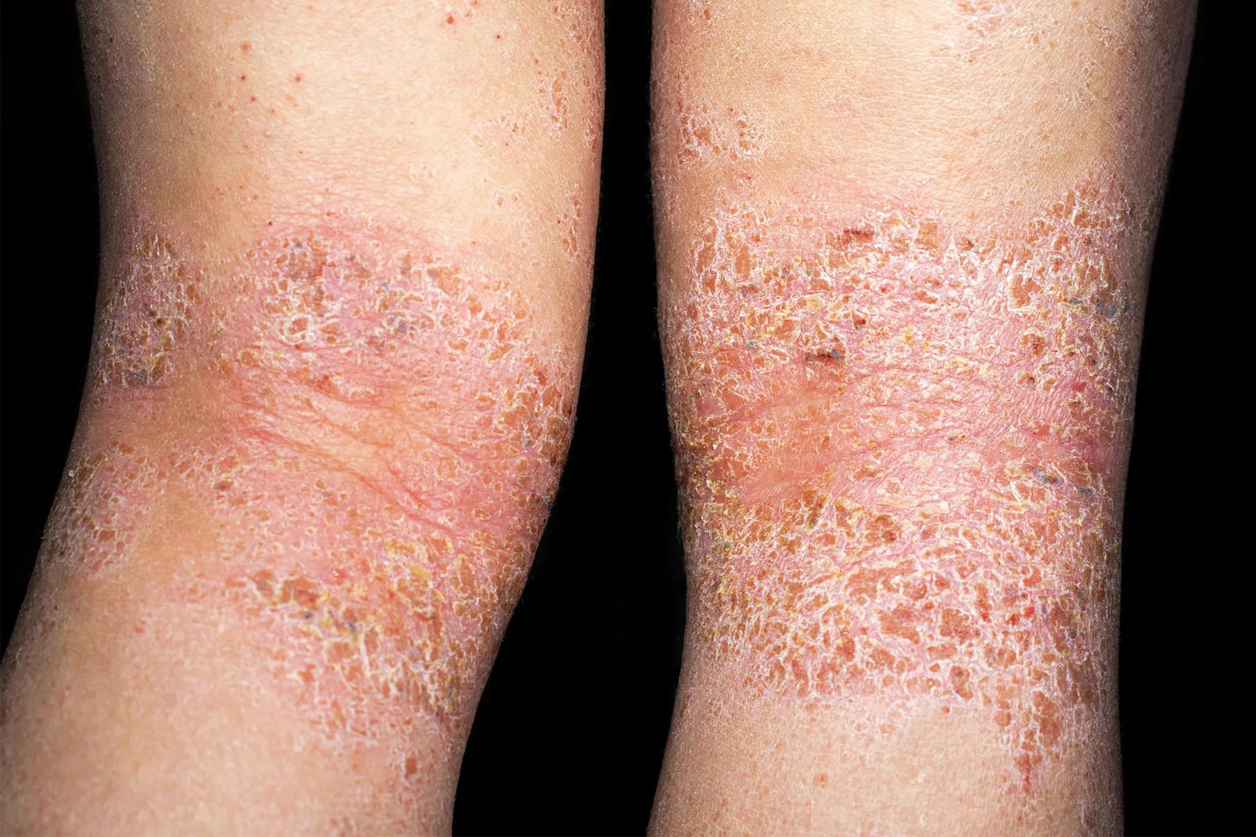 Is It Dry Skin or Atopic Dermatitis?