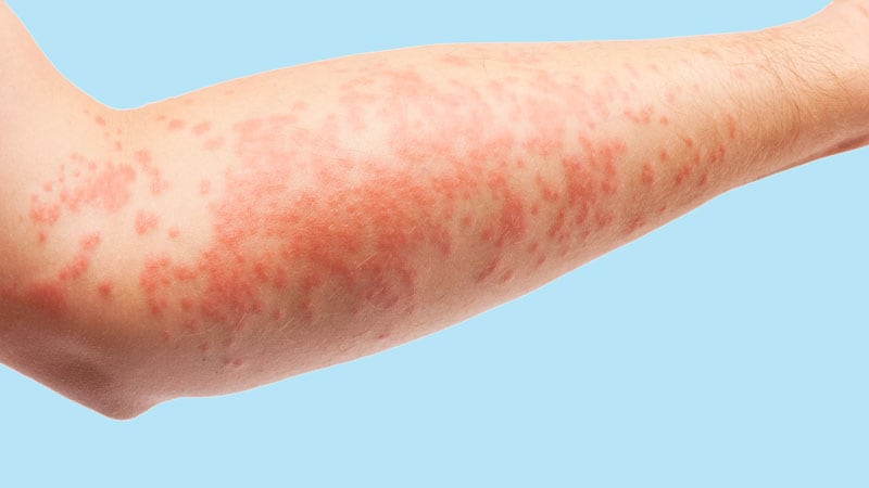 EMA Approves Tx for Psoriasis and Other Autoimmune Disorders
