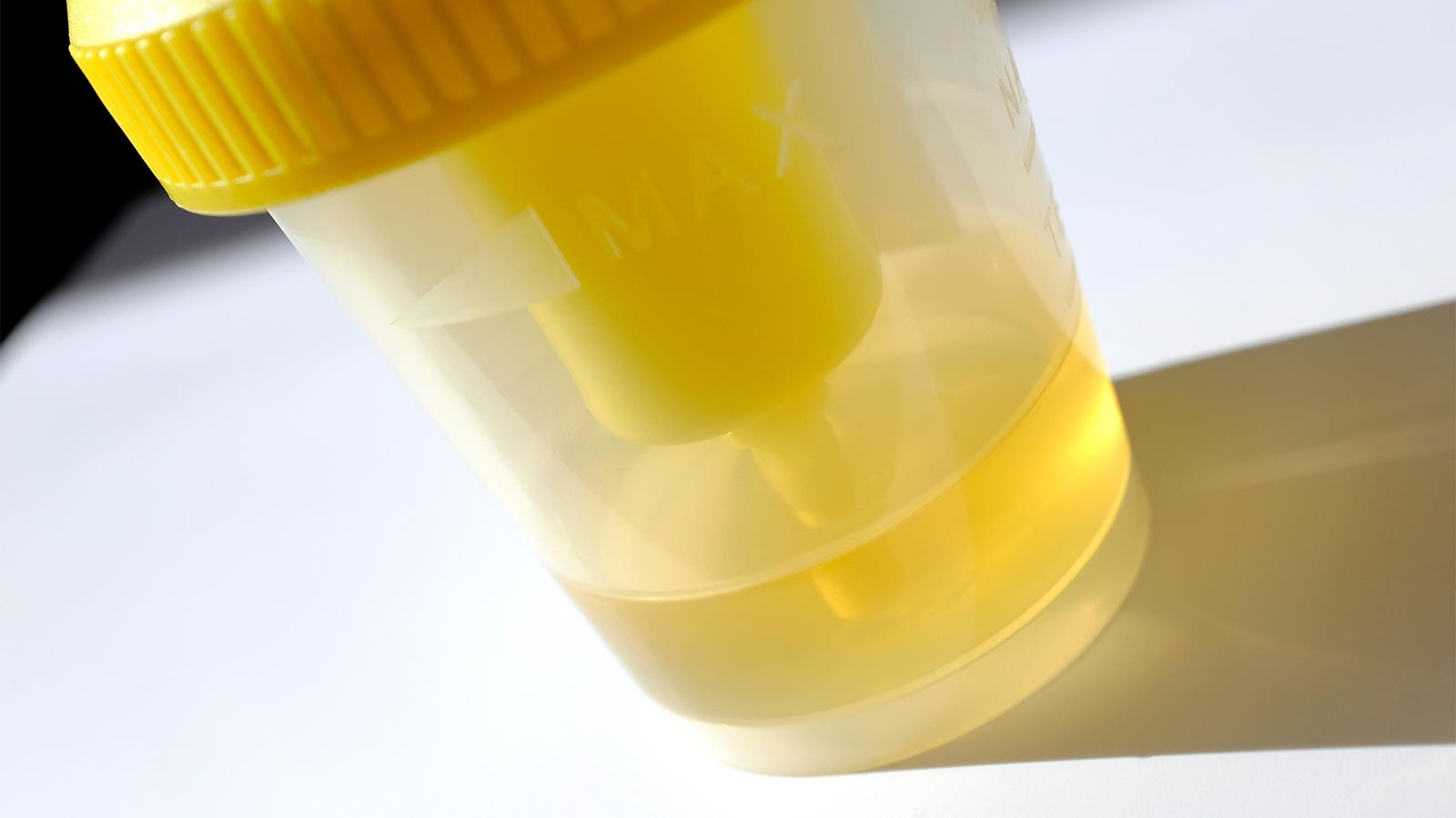Urine Test Accurately Detected High-Grade Prostate Cancer